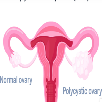 Polycystic Ovarian Disease